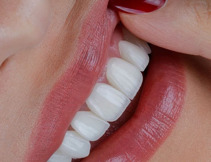 Hollywood Smile in Dubai: Your Guide to a Red Carpet Smile