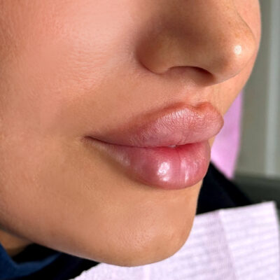 Lips Filler - Creative (1)